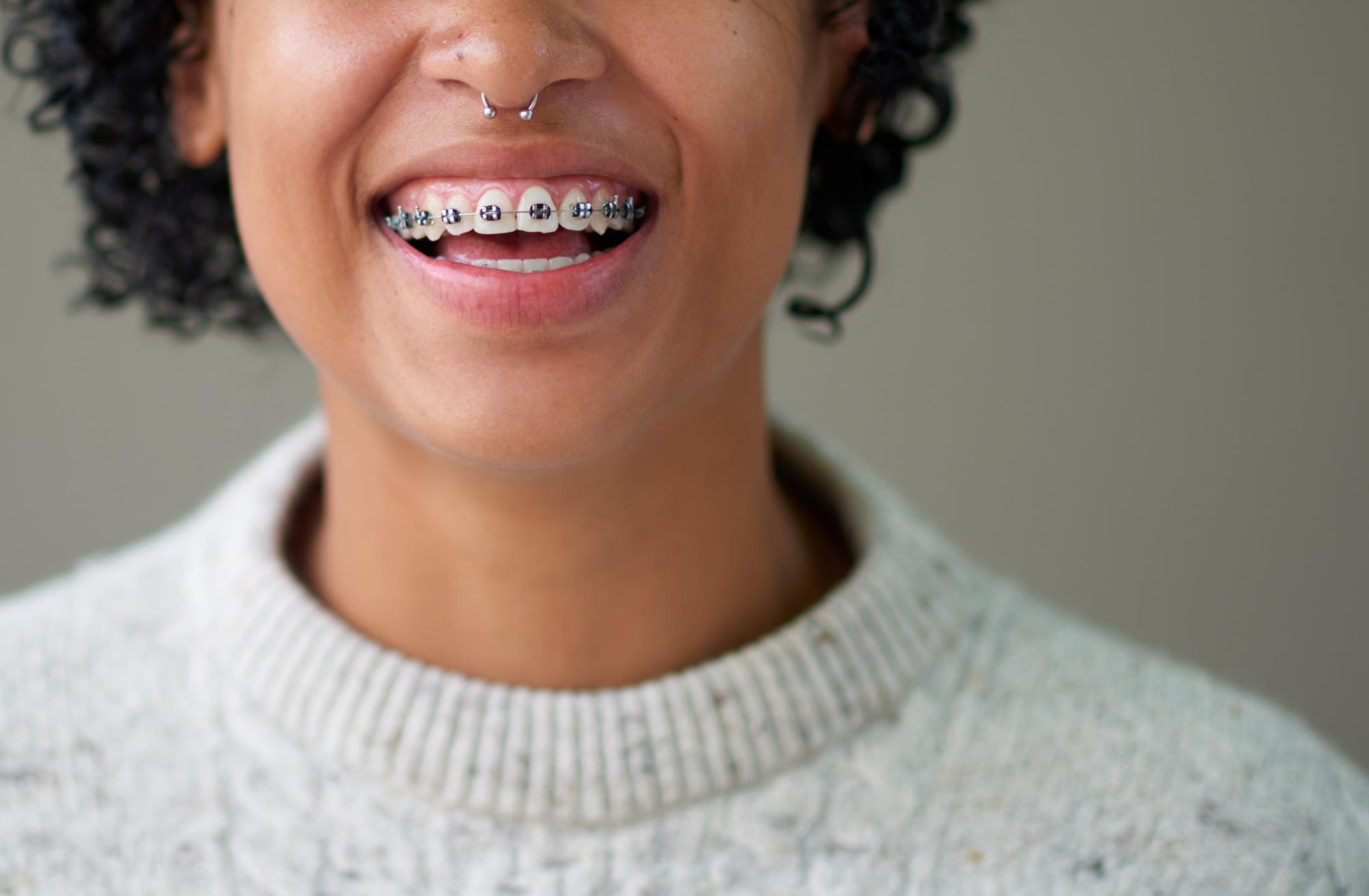 Metal Braces