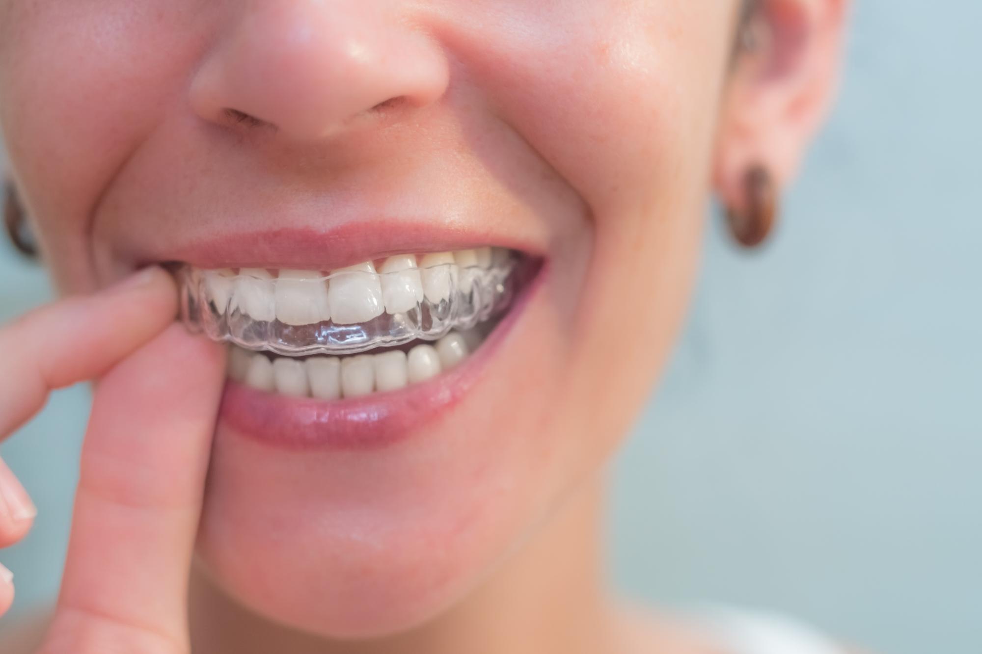 Invisalign